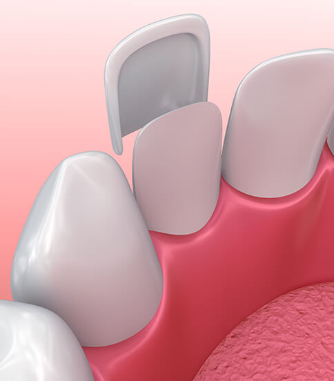 illustration of a dental veneer